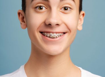 Closeup portrait of surprised boy with dental braces on teeth looking at camera isolated on blue background. Health care, orthodontic concept