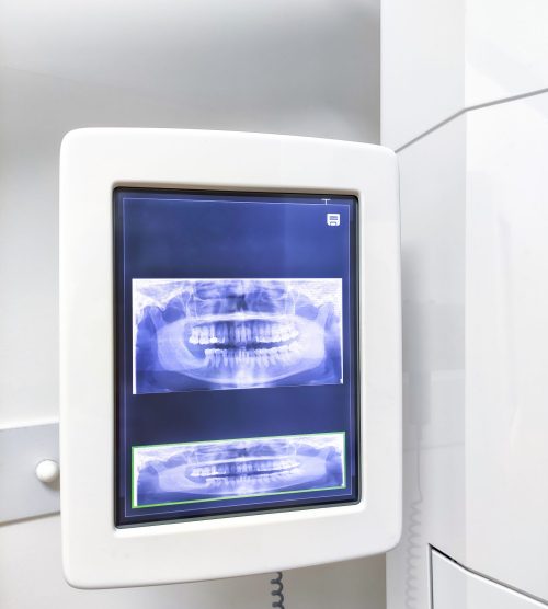 Screen of teeth scan machine in the dental clinic.