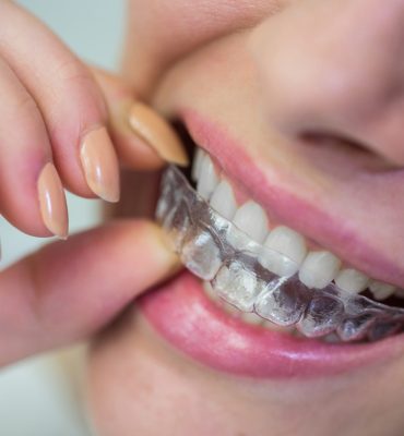 Close-up of woman wearing orthodontic silicone invisible braces